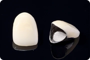 プラスチック銀合金冠 (前歯) 