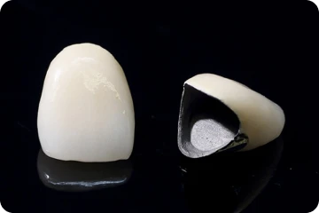 メタルボンド冠