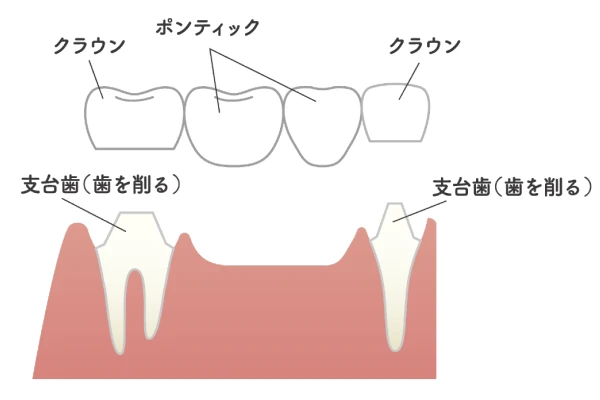 入れ歯について
